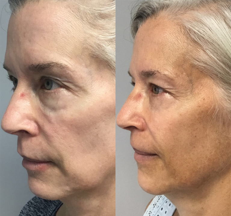 reduce cheek wrinkles Los Angeles