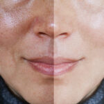 uneven skin tone treatment