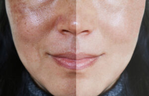 uneven skin tone treatment