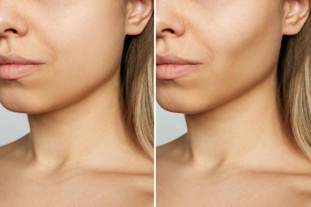 Buccal fat removal for face contouring