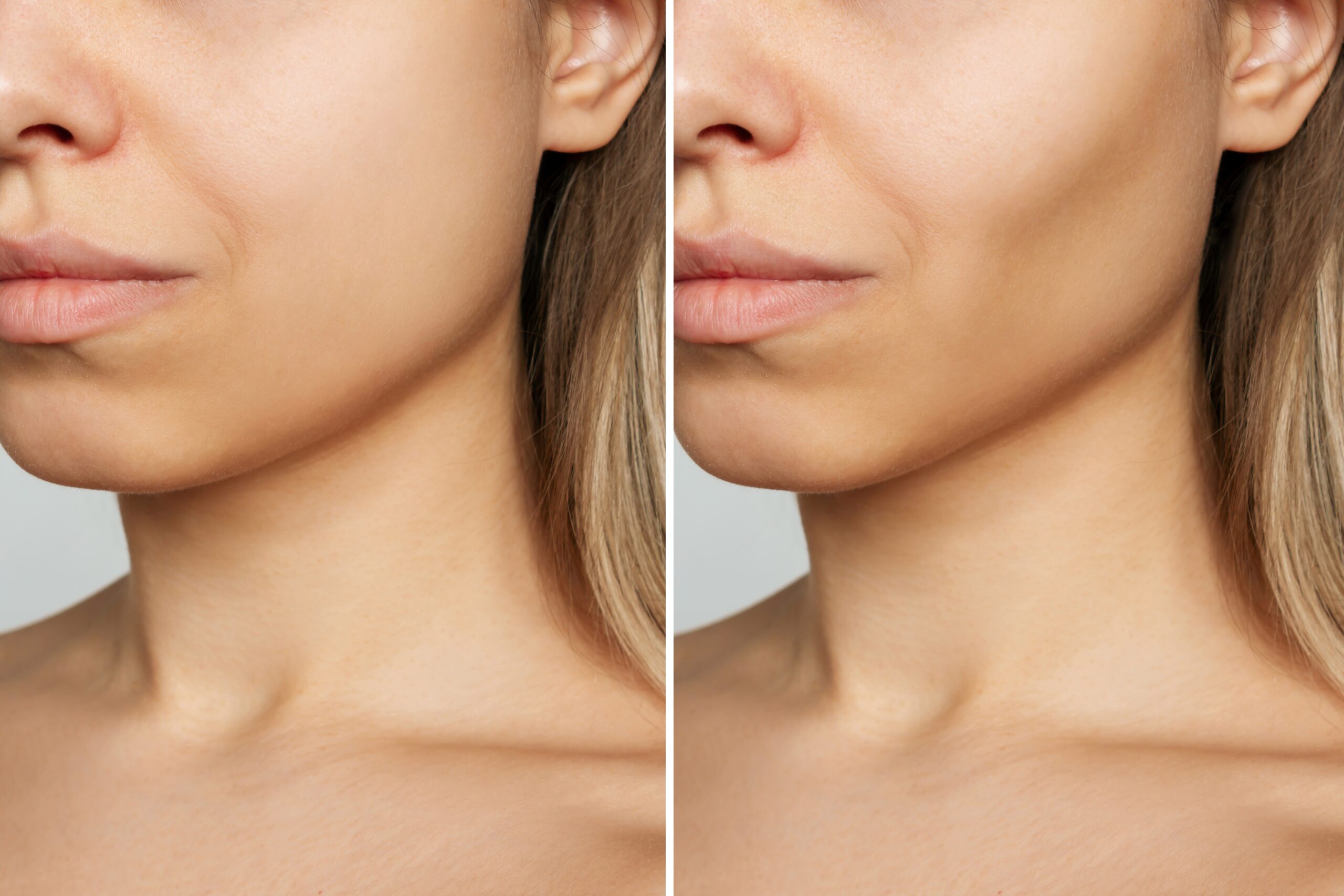 Buccal fat removal