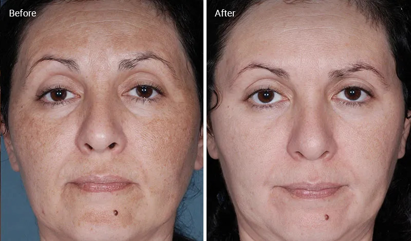 Chemical peels before-after Los Angeles