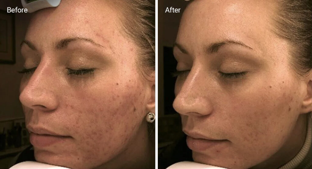 Chemical peels for acne scarring before-after Los Angeles