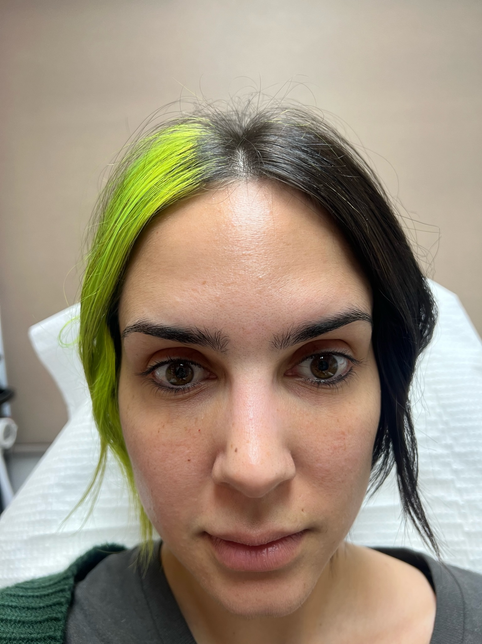 Facial contouring with Botox after