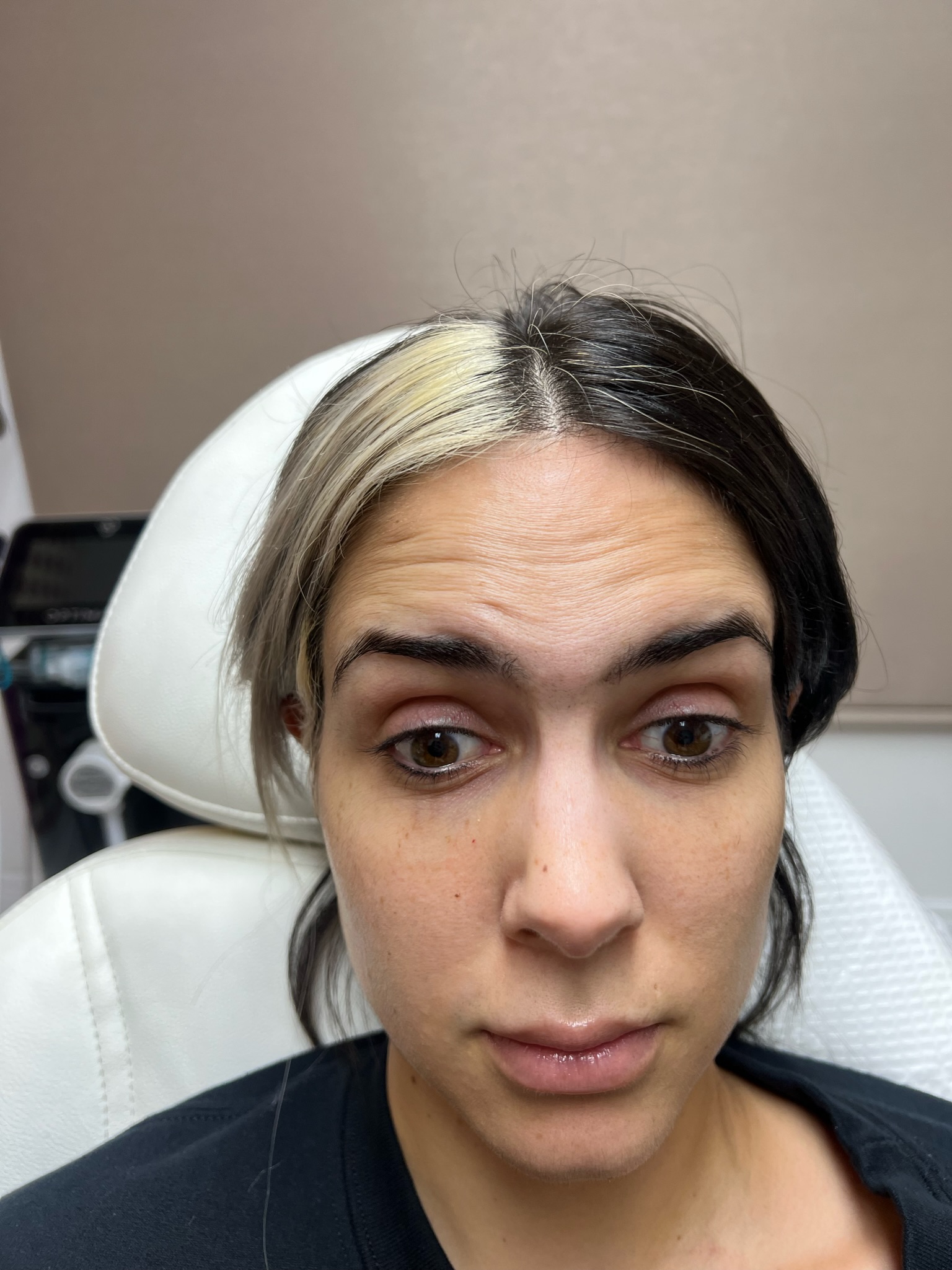 Facial contouring with Botox before