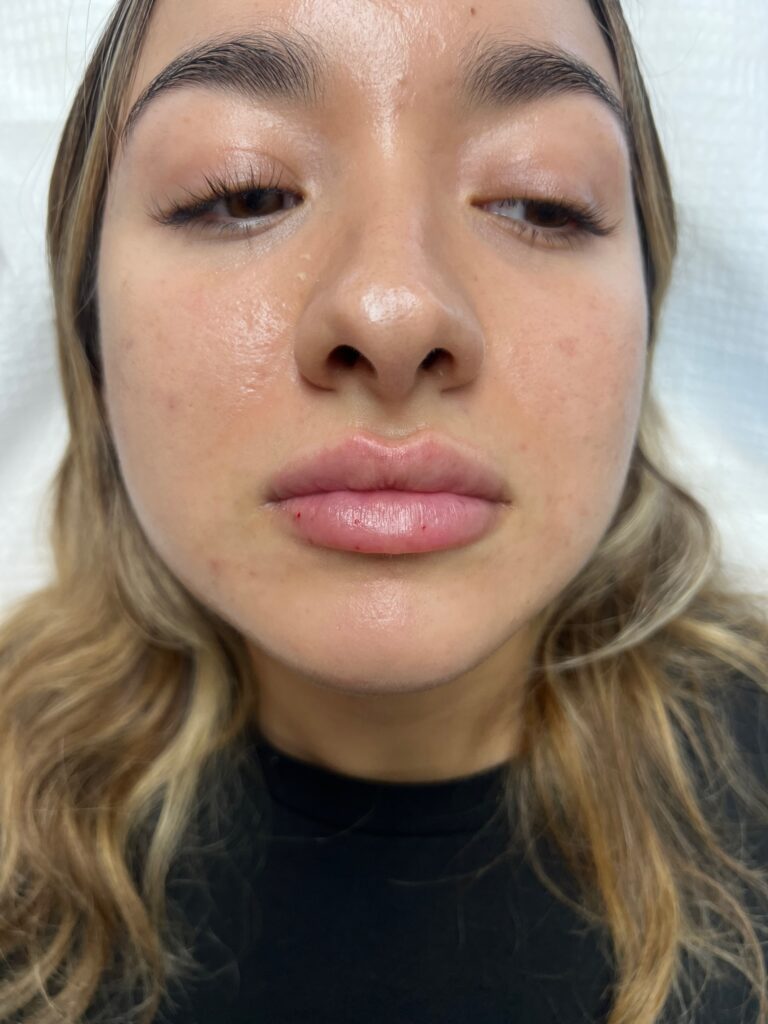 Kysse lip filler after