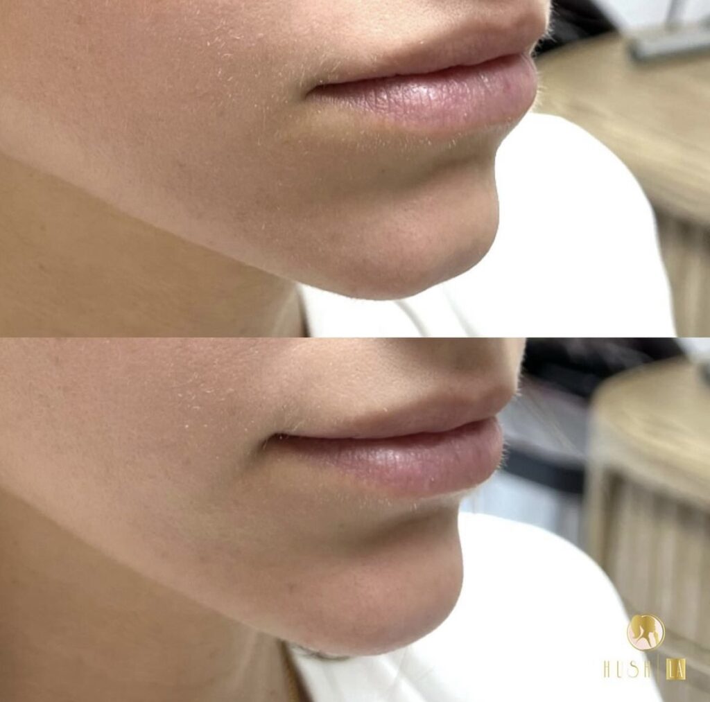 Lip injections Los Angeles