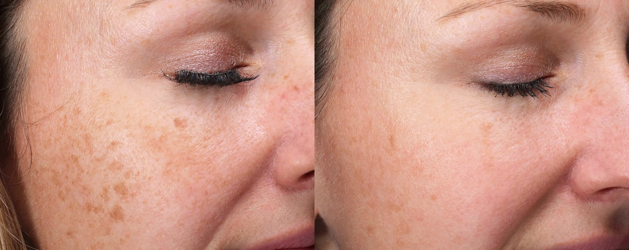 Lumecca IPL treatment Los Angeles