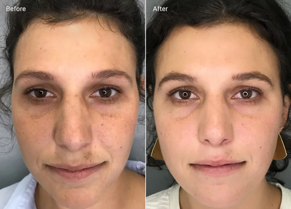 Microneedling for sun damaged skin Los Angeles