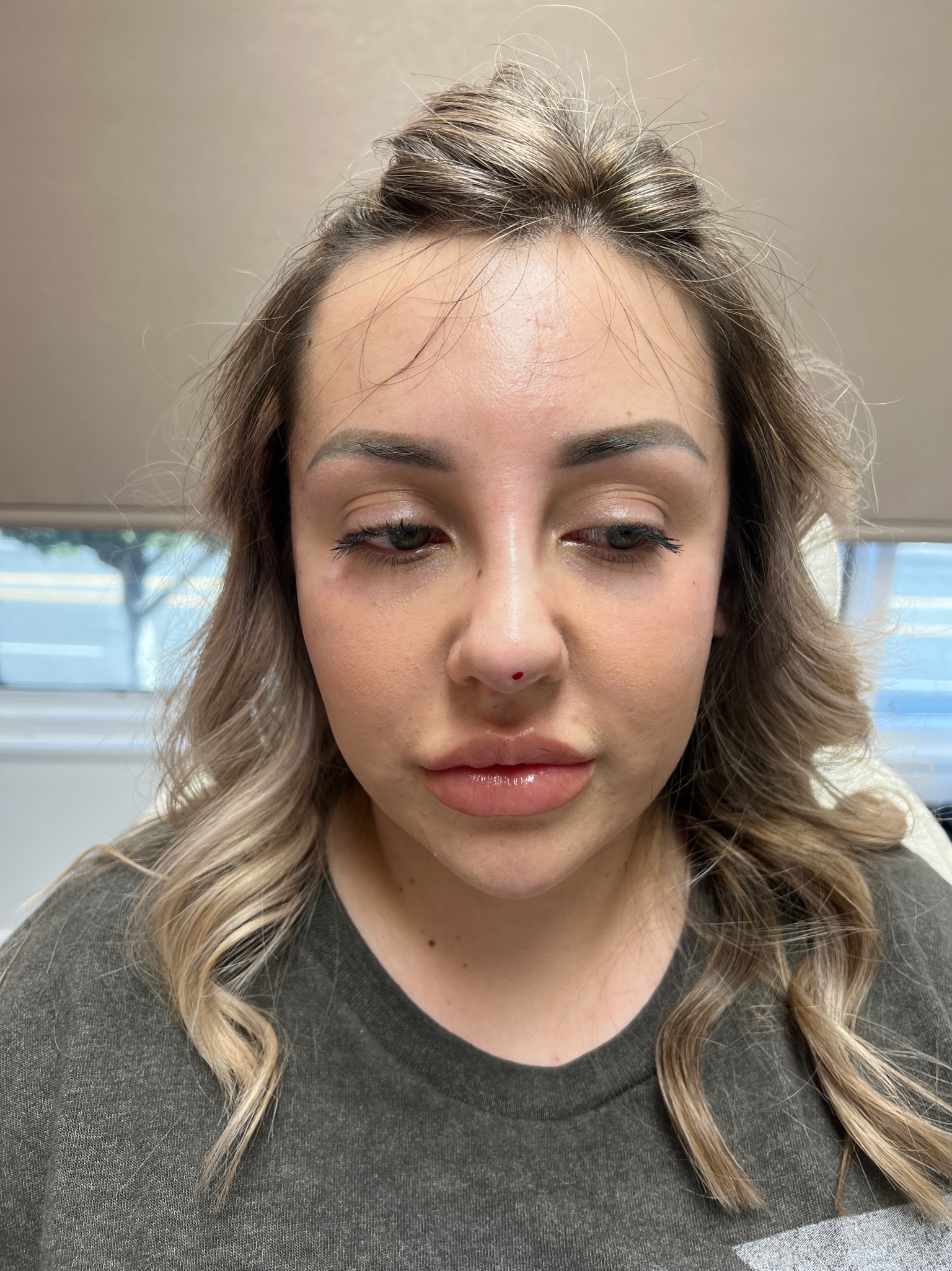 Nose lift with pdo threads after