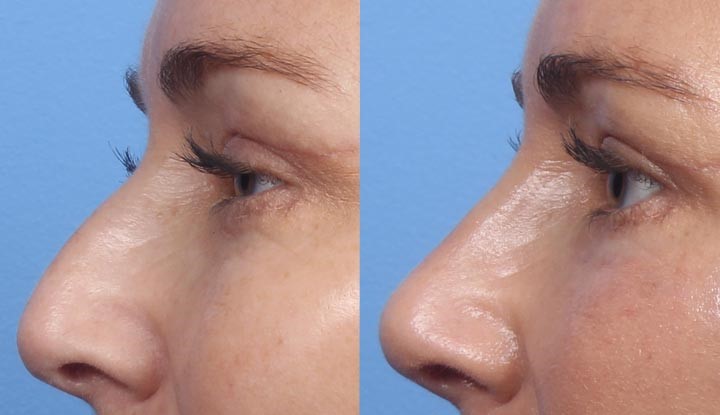 dermal fillers for non-surgical nose job Los Angeles
