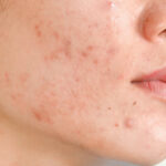 Get rid of pimple scaring Los Angeles