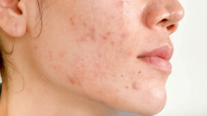 Get rid of pimple scaring Los Angeles