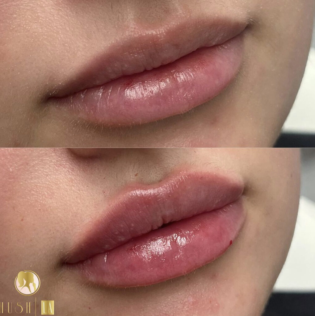 lip correction Los Angeles