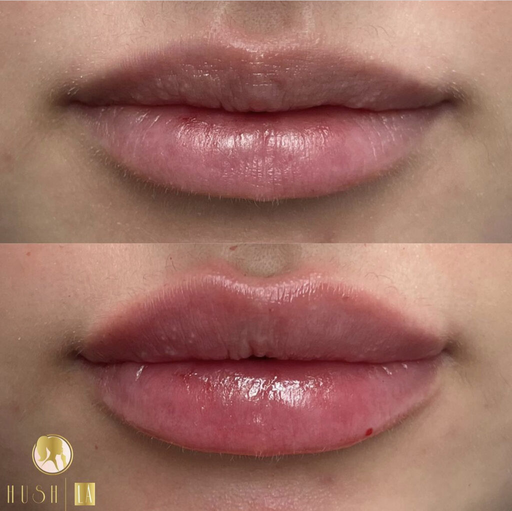 Kysse lip fillers Los Angeles