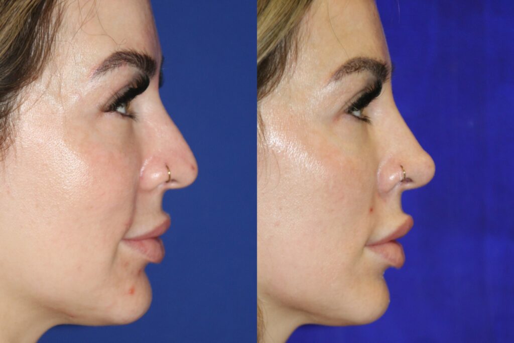 liquid rhinoplasty Los Angeles