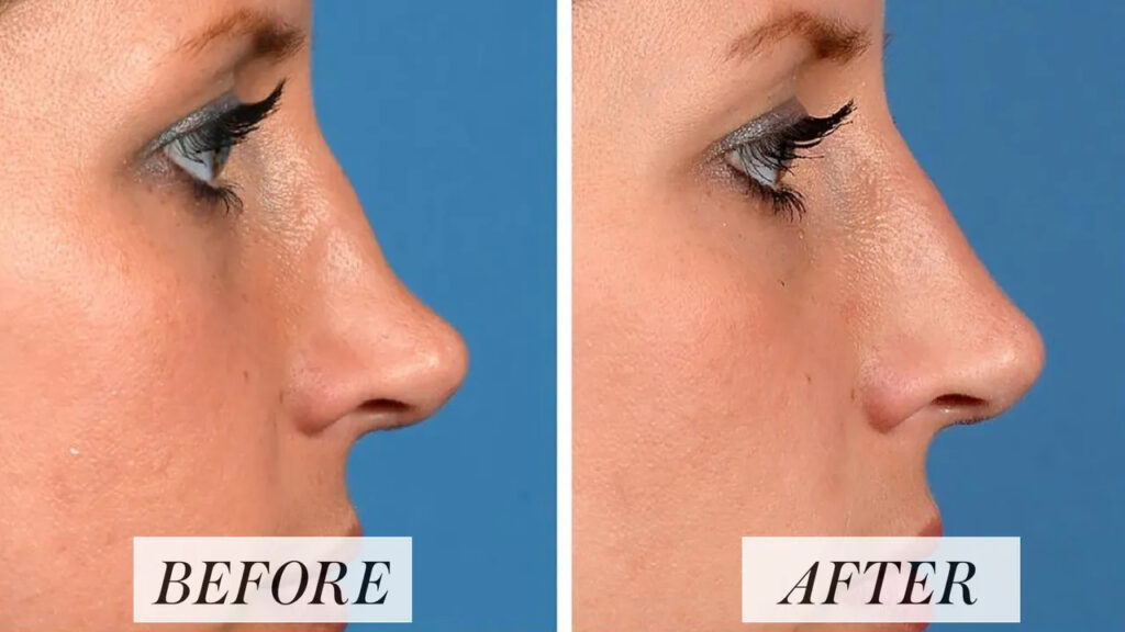 non-surgical nose job before-after Los Angeles