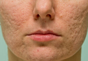 pimple scars treatment Los Angeles