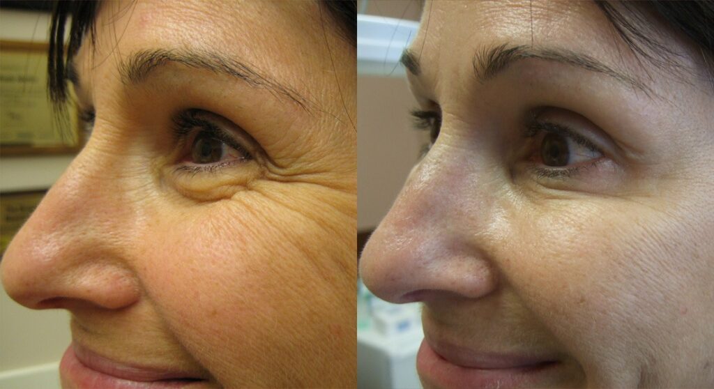 Dermal Fillers for crow’s feet Los Angeles