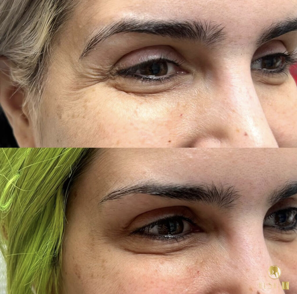 botox injections for Crow's feet