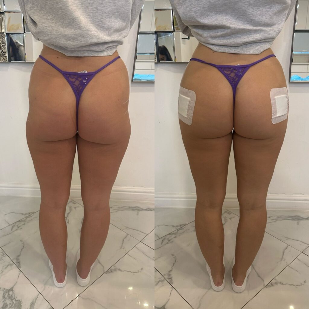 Non-Surgical Butt Lift, Body Contouring, Hip Dip Fillers