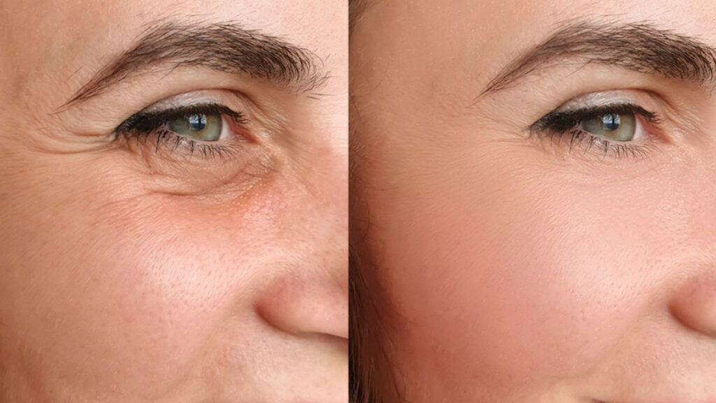 daxxify anti-wrinkles treatment Los Angeles