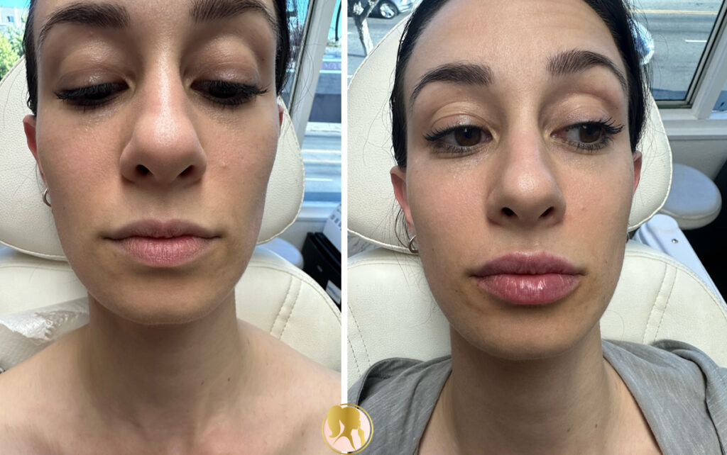 lip augmentation with dermal fillers before-after Los Angeles
