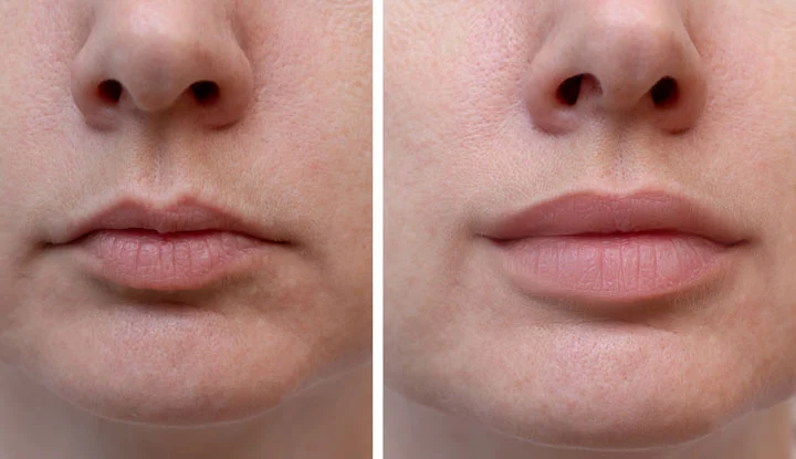 lip augmentation with dermal fillers before-after Los Angeles