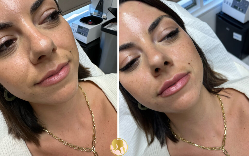 lip filler techniques Los Angeles