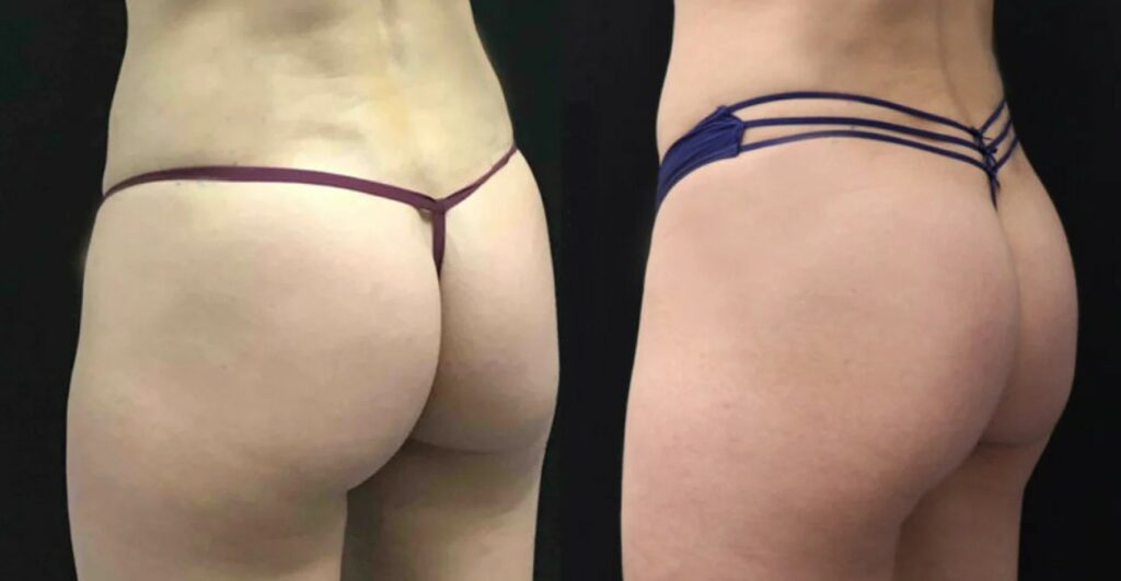 non-surgical butt augmentation Los Angeles