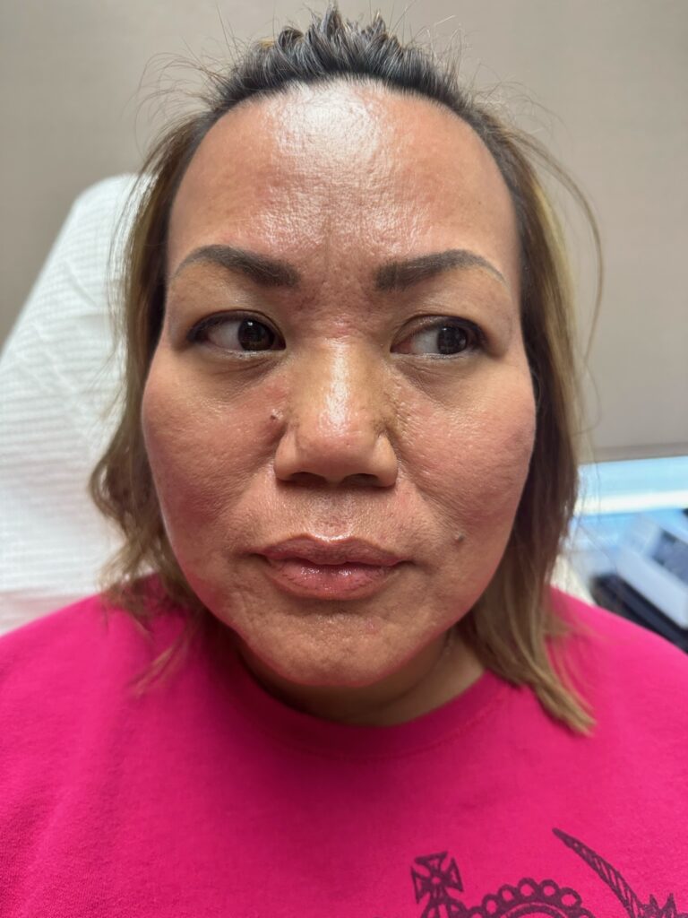 Hush L.A. Medspa - 🧵 Lifting the tip of the nose can make the