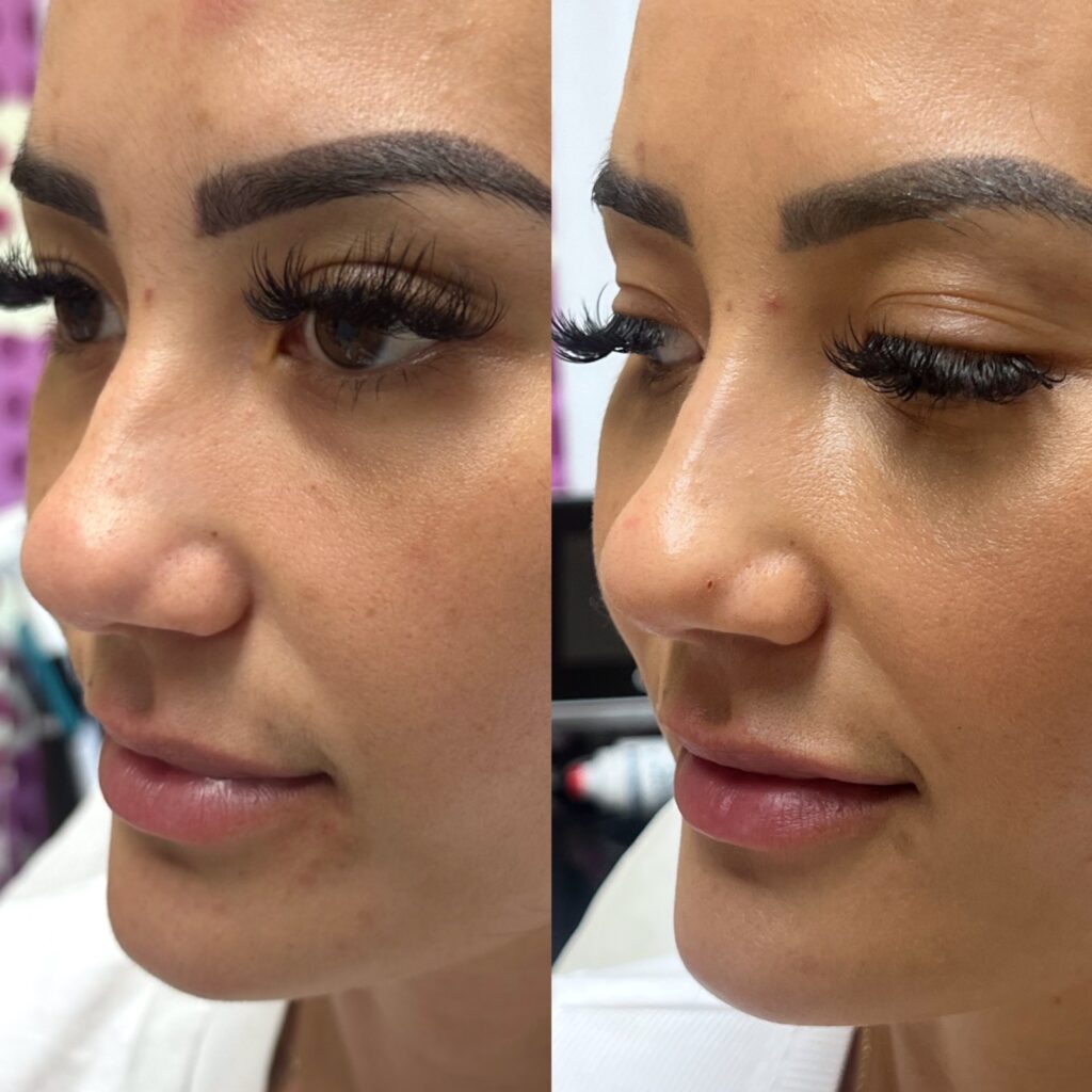 nose thread lift left side