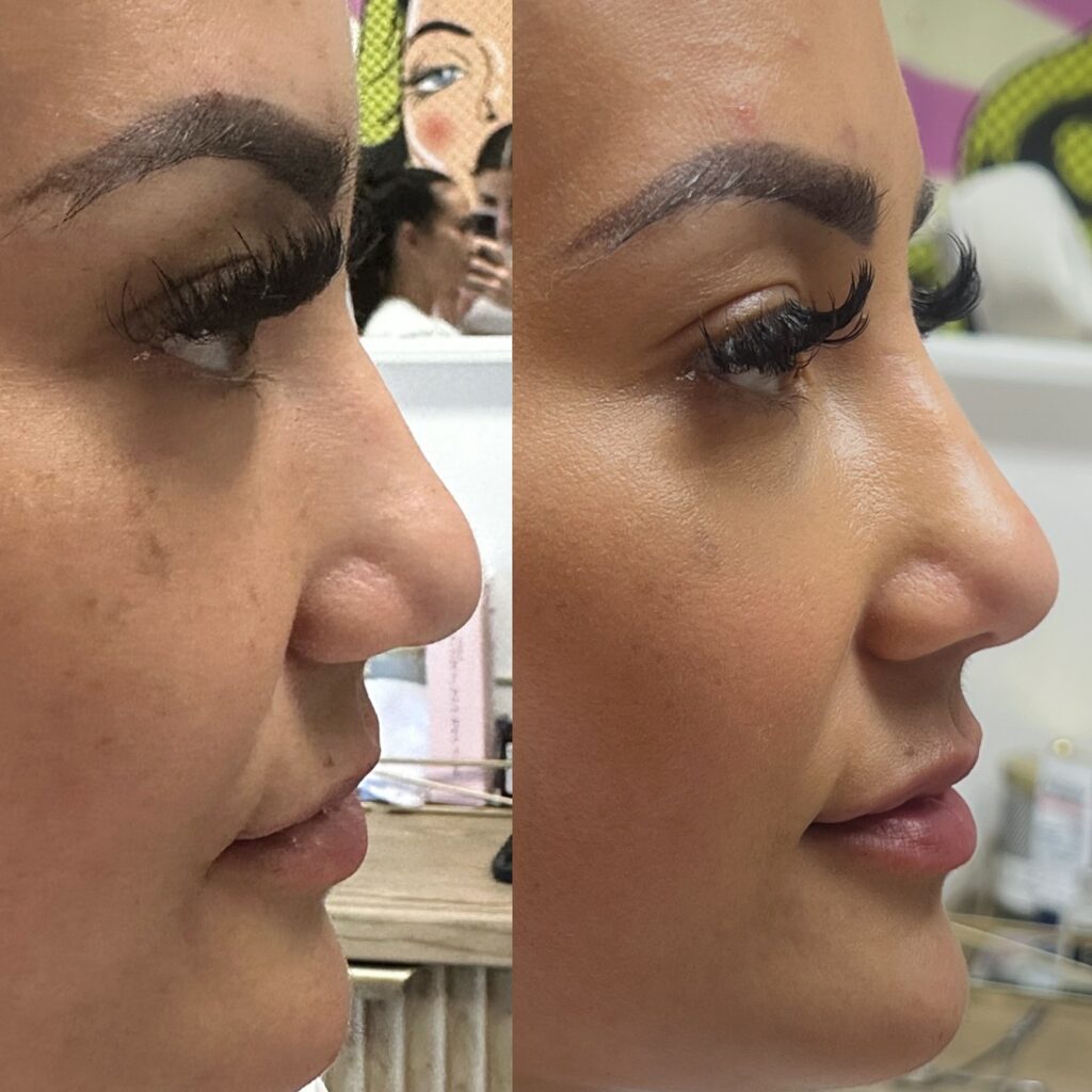 nose thread lift right side