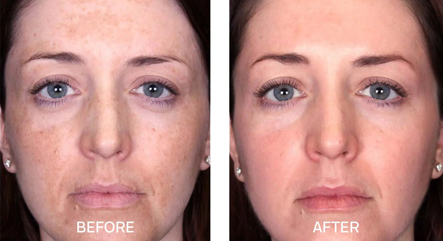 Chemical peeling for face
