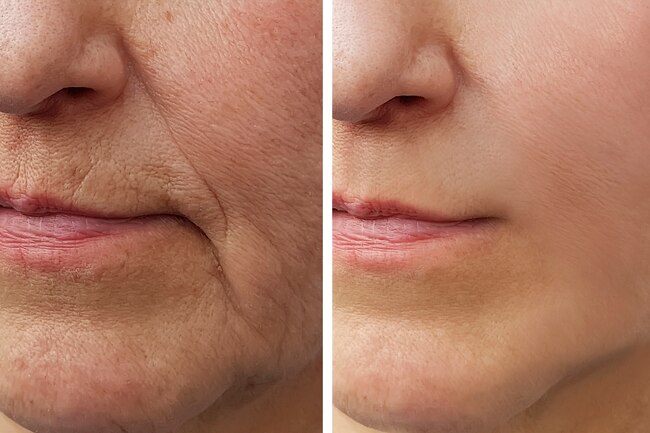 Dermal fillers for skin tightening Los Angeles