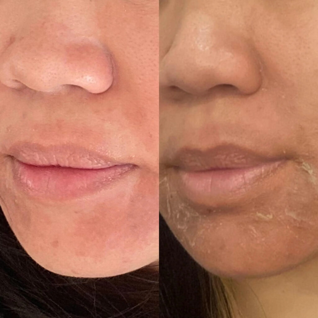 Microneedling before-after Los Angeles