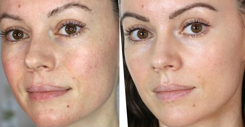 Microneedling before after Los Angeles