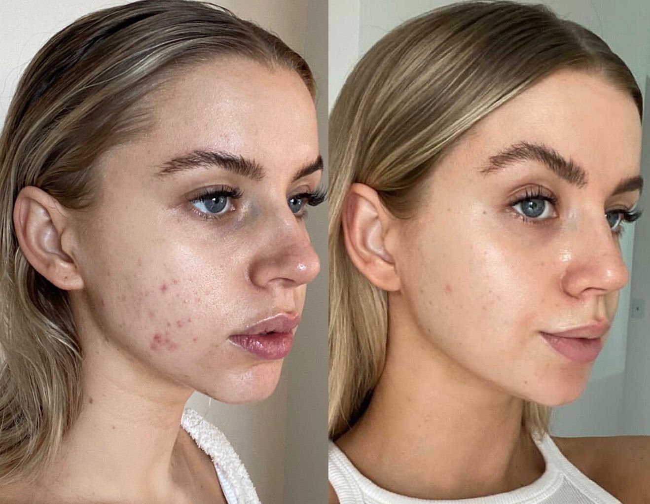 PRP Vampire Facial treatment Los Angeles