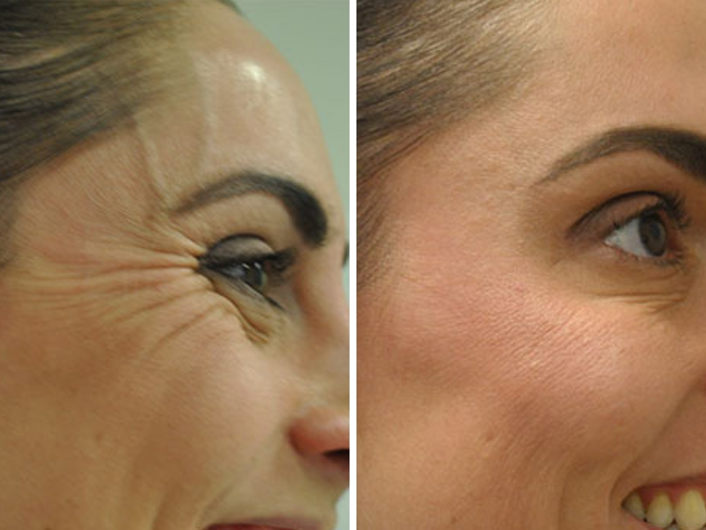 Skin tightening treatment with Botox before after Los Angeles