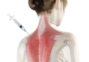 Traptox for the trapezius muscle