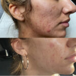 acne treatment with Morpheus 8