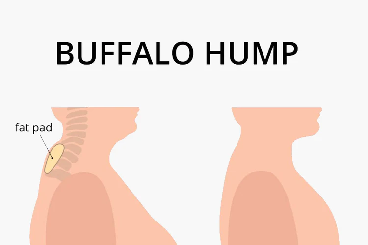 Buffalo Hump: Treatment Options for a Hump Behind the Shoulders