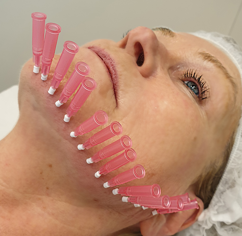 skin tightening treatment with PDO-Threads