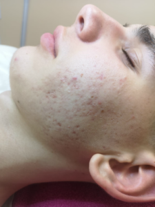 After ACNE-biopeel