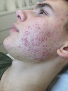 Before ACNE biopeel