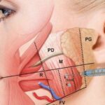 Botox for TMJ pain relief