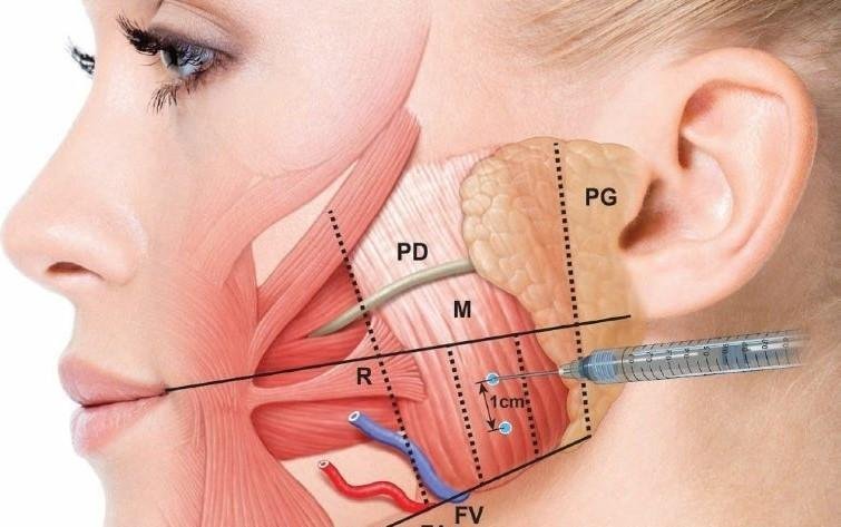 Botox for TMJ pain relief