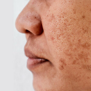 PIGMENTATION and MARKS treatment