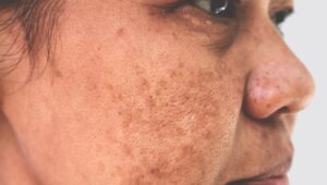 Sun-Damage-and-Pigmentation