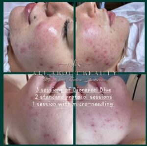 acne treatment via biopeel